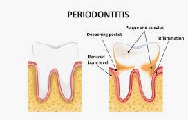 periodontist Singapore