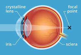 presbyopia 