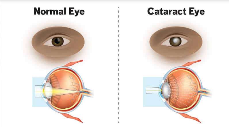 cataract surgeon
