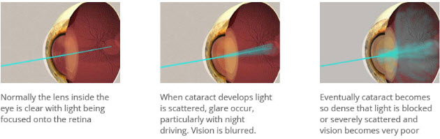 singapore cataract surgery