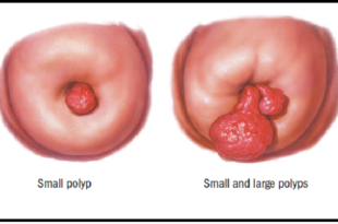 Cervical Polyps