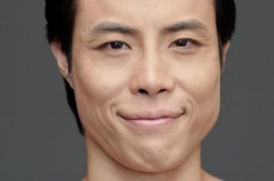 hair transplantation singapore