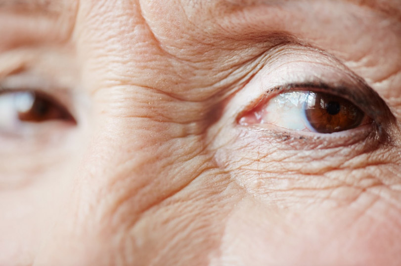 age related macular degeneration