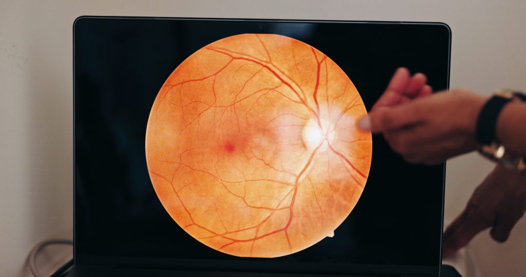 diabetic macular edema
