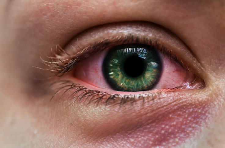 Cataract surgery lens implant
